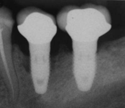 Deep Dive: Does Periodontitis Predict Implant Failure and Peri-Implantitis?